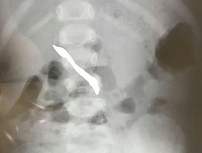 X-ray of nail clippers in baby's stomach